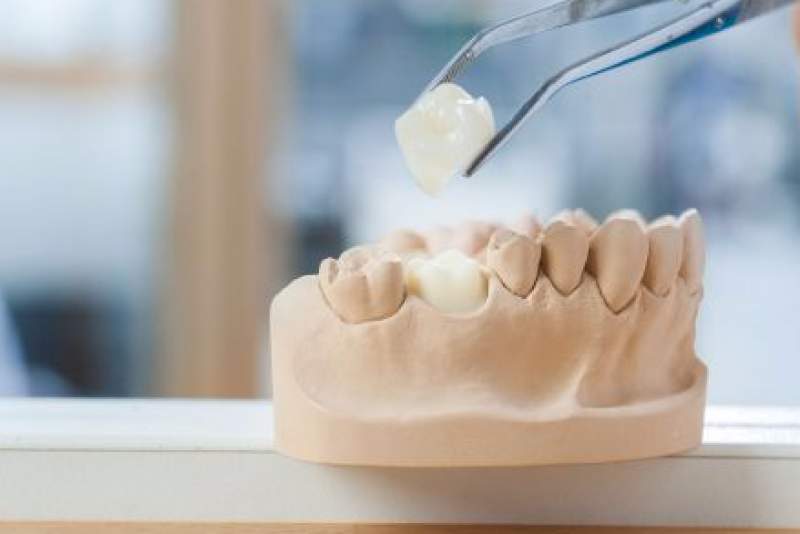 Galeriebild pirina-dental-keramikkrone.jpg